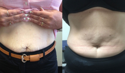 bariatric sleeve before and after